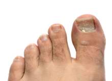 Mantar Enfeksiyonlu Tırnağı Ameliyatsız Çektirme İşlemi Mantar Enfeksiyonlu Tırnağı Ameliyatsız Çektirme İşlemi