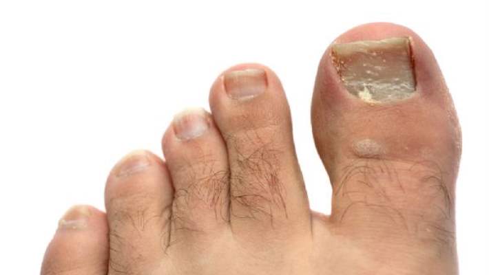 mantar enfeksiyonlu tirnagi ameliyatsiz