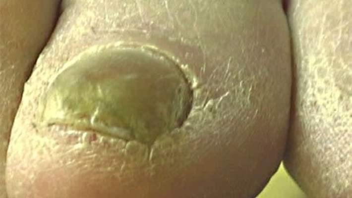 Tırnak Mantarı Enfeksiyonunu Tedavi Etmek İçin Mantar İlacı Almalı Mıyım?