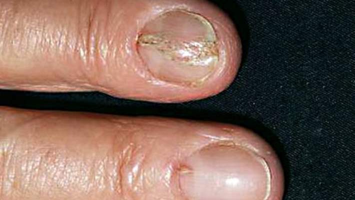 Tırnak Mantarının Farklı Türlerini Tespit Etmek