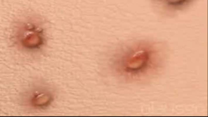 Suçiçeği Aşısı