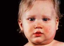 Krup Hastalığı İle Başa Çıkmak Krup Hastalığı İle Başa Çıkmak