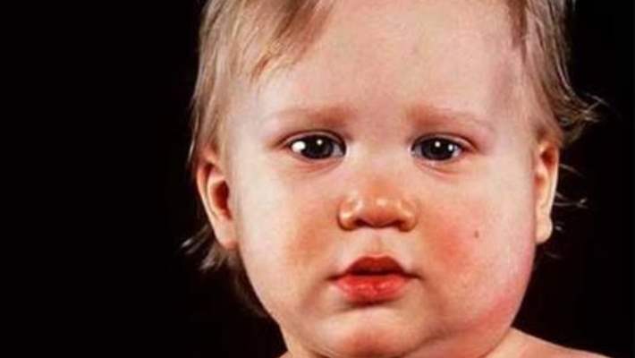 Krup Hastalığı İle Başa Çıkmak