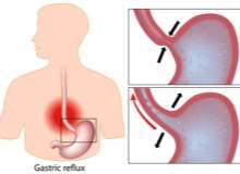 Reflü Krupa Etki Edebilir Reflü Krupa Etki Edebilir