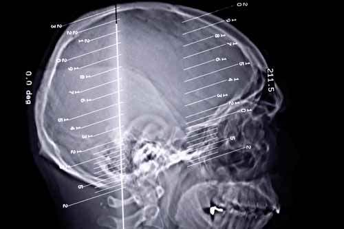 Genel Olarak Epilepsi (Şuur Uyuşması veya Petit Mal Epilepsi)