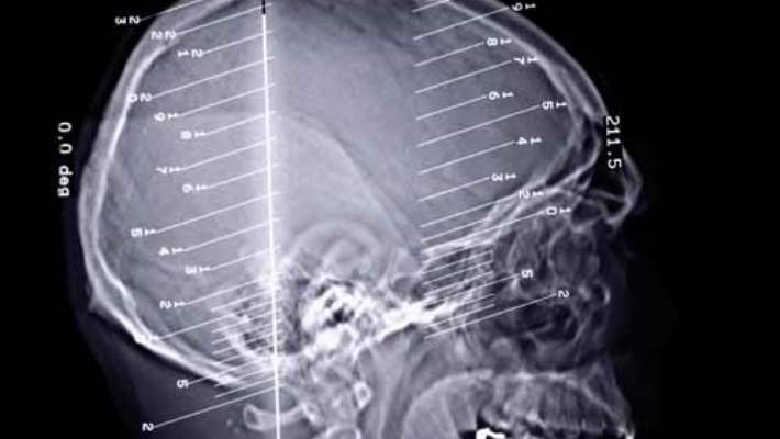 Genel Olarak Epilepsi (Şuur Uyuşması Veya Petit Mal Epilepsi)
