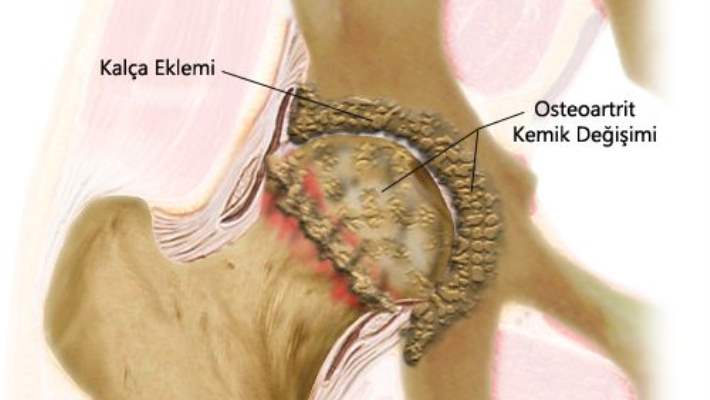 Osteoartrit Sebepleri