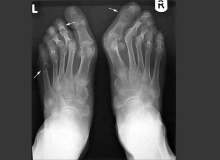 Romatoid Artritte Eklem Hasarlarının Önlenmesi Romatoid Artritte Eklem Hasarlarının Önlenmesi
