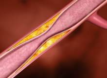 Radyofrekans Ablasyon Operasyon Sonrası Daha Az Ağrıya Neden Oluyor Radyofrekans Ablasyon Operasyon Sonrası Daha Az Ağrıya Neden Oluyor