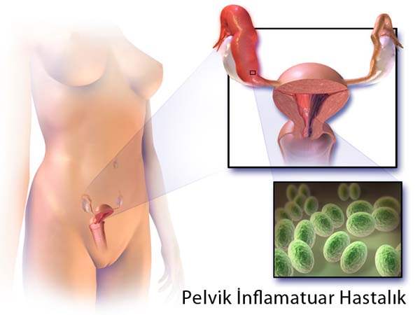 Pelvik Ağrıyla İlgili Yanlış Bilgiler