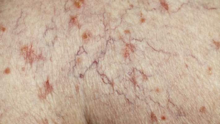 Hamilelikte Varis Nasıl Önlenir