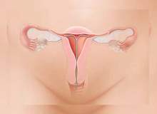 Endometriyozda Beslenme Endometriyozda Beslenme