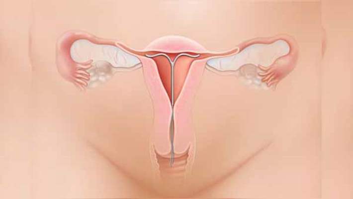 Endometriyozda Beslenme