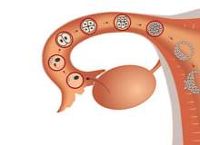 Endometriyozda Ağrıyı Azaltma Endometriyozda Ağrıyı Azaltma