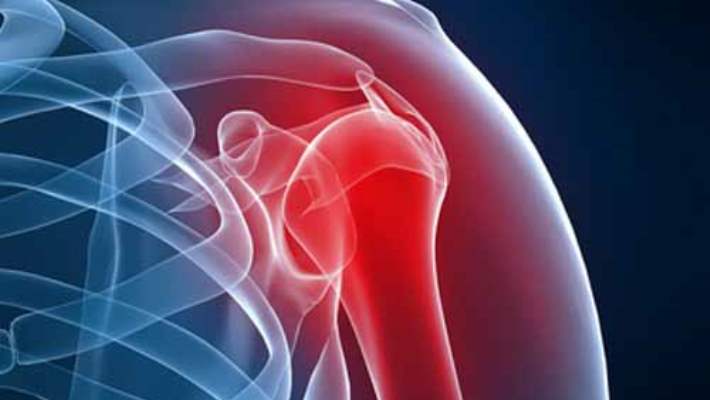 Rotator Manşon Ameliyatından Sonra Omuz Faaliyeti Tamamen Eski Haline Dönmüyor