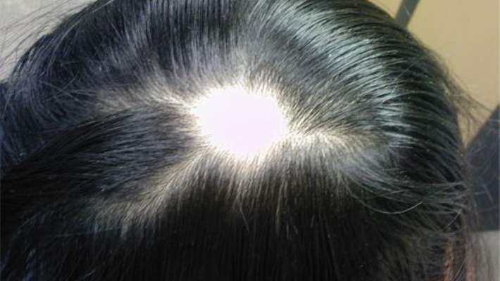 İnsanlarda Saçkıranı Önlemek