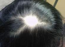 Yüzünüzdeki Saçkırandan Nasıl Kurtulursunuz Yüzünüzdeki Saçkırandan Nasıl Kurtulursunuz