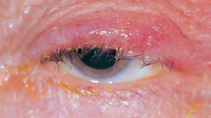Göz Kapağı İltihaplarıyla Ve Enfeksiyonlarıyla Başa Çıkma