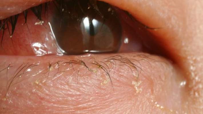 Göz İltihabı Ve Göz Çapağının Diğer Sırları Açıklanıyor!