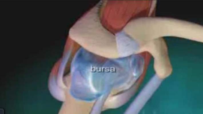 Bursit Nasıl Yenilir?