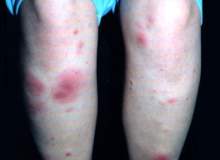 Dermatomiyozit Dermatomiyozit