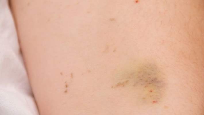 kolay olusan curuklerin nedeni nedir hemen saglik kolay olusan curuklerin nedeni nedir hemen saglik