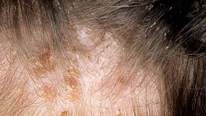 Saç Derisinin İhmali Saç Derisi Problemlerine Yol Açabilir