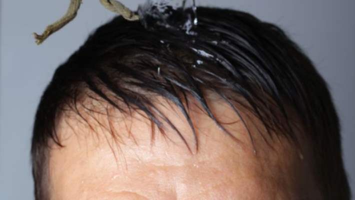 Sıcak Yorgunluğu Evde Nasıl Tedavi Edilir