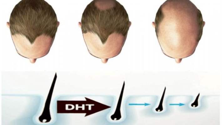 Genetik Sac Dokulmesi Hairneva