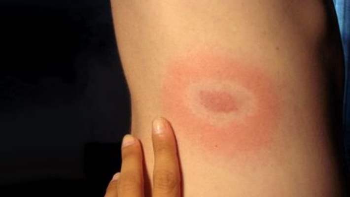 Lyme Hastalığı: Yanlışlar Ve Doğrular