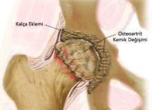 Osteoporoz Ve Kemik Erimesiyle İlgili Altı Hastalık