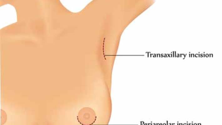 Sarkan Göğüslerinizden Memnun Değil Misiniz? Göğüs Kaldırma Operasyonu İle Göğüslerinizi Kaldırın Ve Tekrar Şekillendirin!