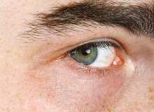 Koyu Renkli Halkalardan Kurtulun, Güzel Gözlere Kavuşun Koyu Renkli Halkalardan Kurtulun, Güzel Gözlere Kavuşun