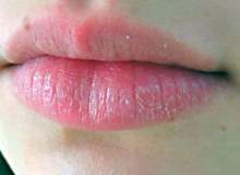 Sorununuz Çatlamış Dudaklar Mı? Sorununuz Çatlamış Dudaklar Mı?