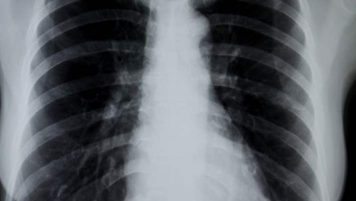 Akut Bronşitin Tedavisi