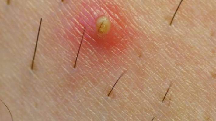 Kıl Dönmesiyle Nasıl Başa Çıkılır?