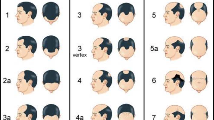 Saç Ekimi Ameliyatı: Kalıcı Sonuçlar Veren En İyi Yöntem