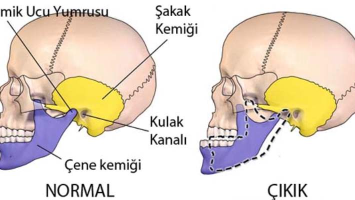 Çene Ucu Ameliyatı