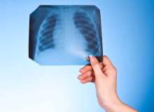 Göğüs Röntgeniyle Kalp Hastalıkları Teşhisi