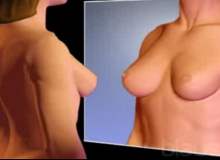 Göğüs Dikleştirme Ameliyatı Nedir