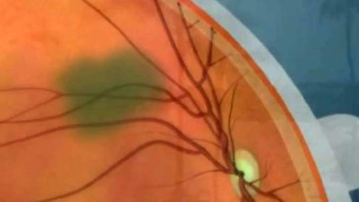 Körlüğe Karşı Yeni Umut