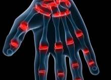 Replantasyon Replantasyon