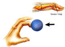 Çekiç Parmak (Beyzbolcu Parmağı) Çekiç Parmak (Beyzbolcu Parmağı)