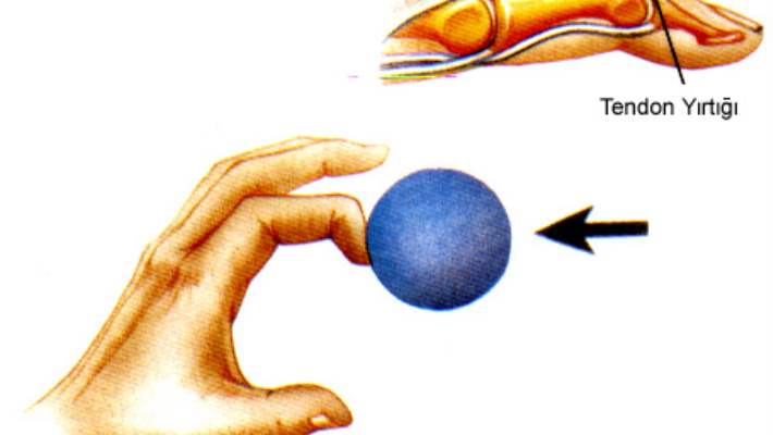 Çekiç Parmak (Beyzbolcu Parmağı)