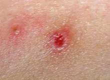 Çıban Sebepleri Çıban Sebepleri