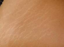 Doğru Çatlak Kremini Kullanarak Çatlaklarınızdan Kurtulun Doğru Çatlak Kremini Kullanarak Çatlaklarınızdan Kurtulun