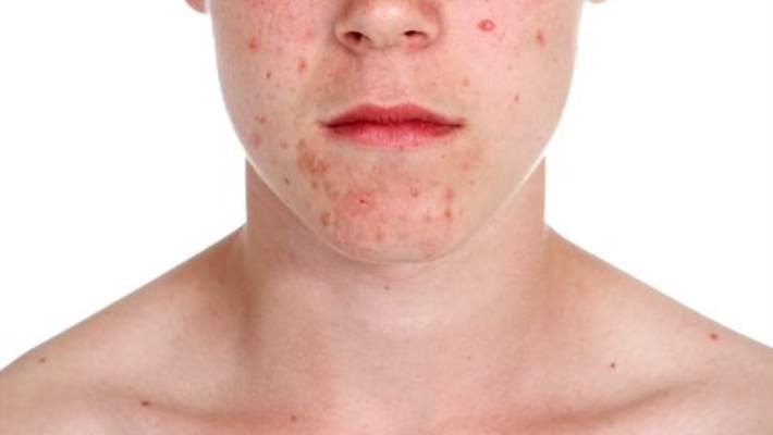 Sivilce İzleriyle Başa Çıkma