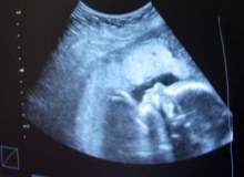 Kadınların Kürtaj Nedenleri Kadınların Kürtaj Nedenleri