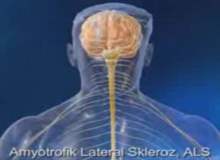 Amyotrofik Lateral Sklerozun (ALS) Nedeni Tespit Edildi
