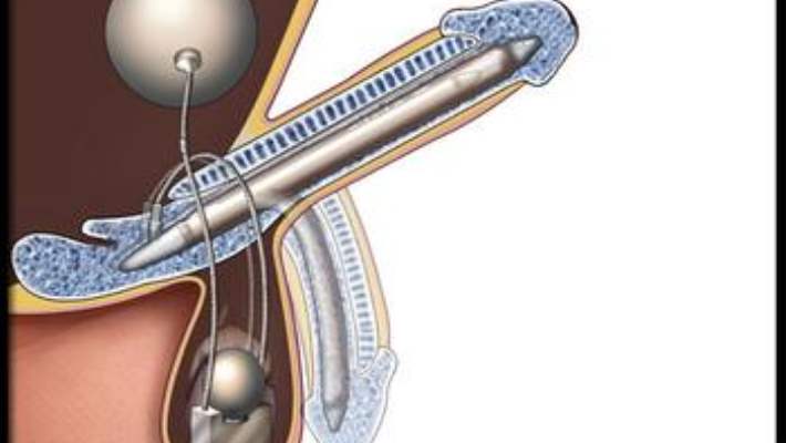 Penis Protezinin Kullanım Ömrü Ne Kadardır?